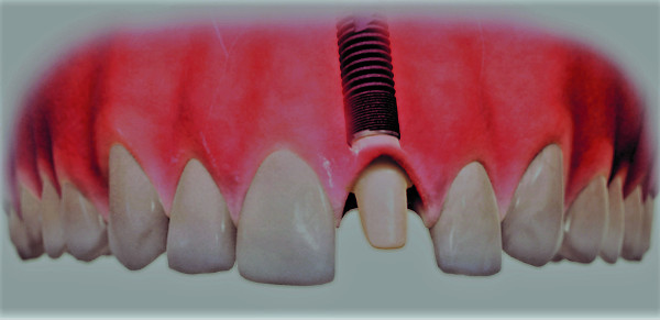 Was ist ein Implantat?