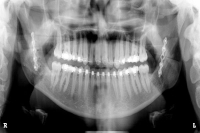 Fehlbisslagen - Dysgnathien