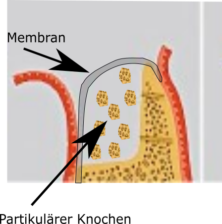 Es fehlt Knochen - was nun?