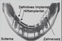 Sofort feste Zähne?