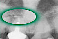 Wurzelspitzenresektion